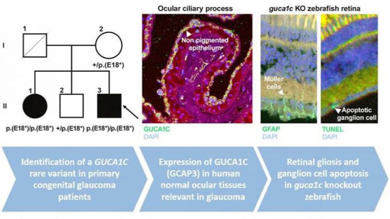 Descubierto un nuevo gen candidato que evidencia la complejidad de las alteraciones del glaucoma congénito